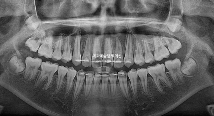 덧니 반대교합 과개교합 인비절라인 퍼스트 악궁확장 어린이 교정 치료 관련 이미지 23