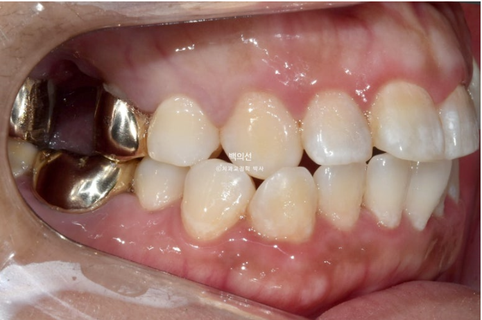 거미스마일 교정 돌출입 발치교정 입술부전 호두턱 치료기간 2년반 관련 이미지 3