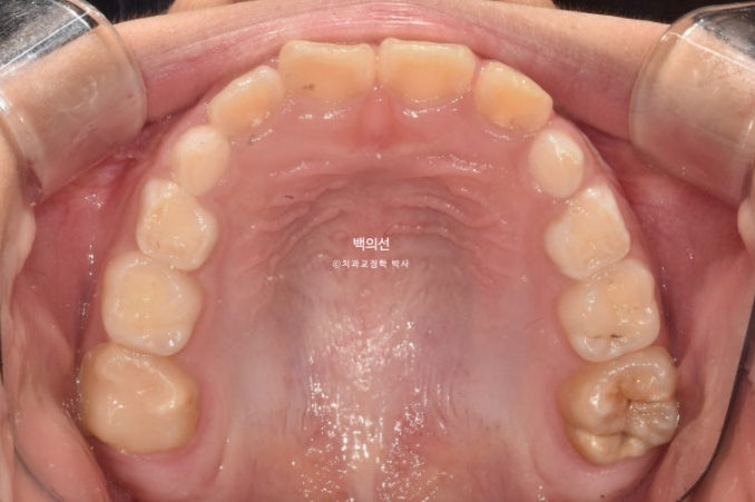 소아 비대칭 교정 인비절라인 퍼스트 재제작 1회 MA 치료 관련 이미지 6
