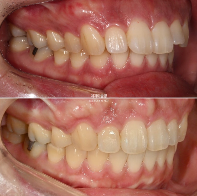 Extraction Orthodontics with Clippy-C for Protruding Mouth, Gum Smile, Gummy Smile Correction, and Treatment for a Recessed Chin image 16