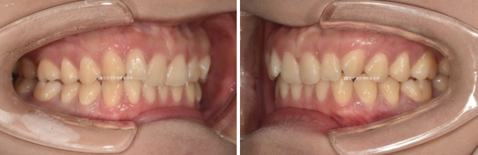 압구정 교정치과 / 옥니교정 인비절라인 라이트 덧니교정 관련 이미지 3