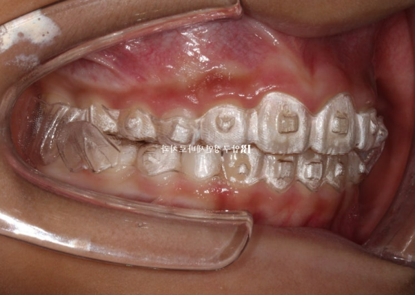 Invisalign First Correction for a Retruded Chin in a Child Orthodontic Treatment for Protrusion image 10