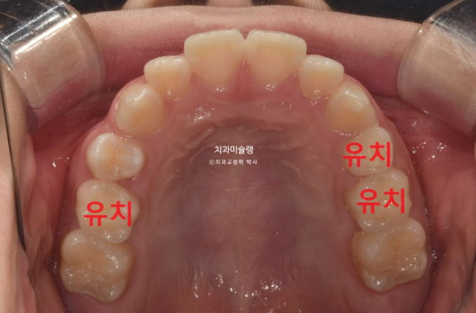 돌출입 비발치 어린이 교정 입술부전증 호두주름 호두턱 토끼이빨 인비절라인퍼스트 관련 이미지 4