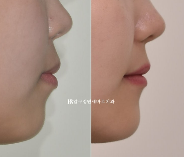 인비절라인 돌출입 발치교정, 정말 결과가 안 좋을까요? 관련 이미지 15
