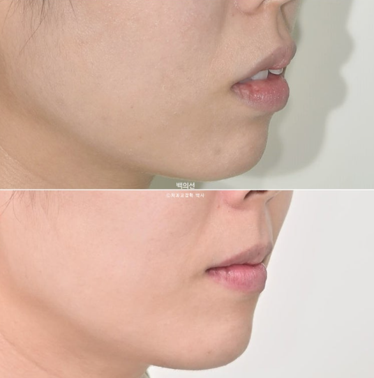 30대 돌출입 덧니 교정 인비절라인 발치교정 후기 관련 이미지 21