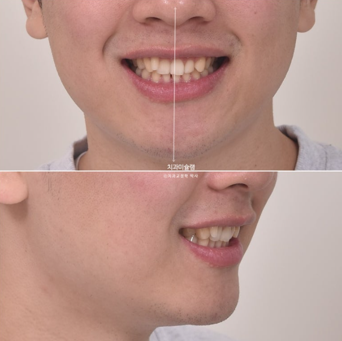 옥니 덧니 교정 왜소치 선천적 결손 3전치 무삭제 라미네이트 인비절라인 교정 관련 이미지 5