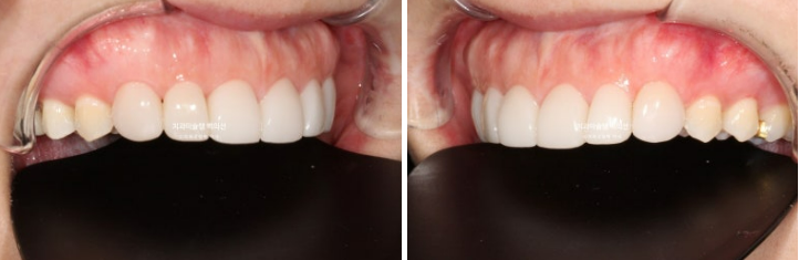 비발치 덧니 교정 인비절라인 과개교합 교정 무삭제 라미네이트 치료 후기 관련 이미지 15
