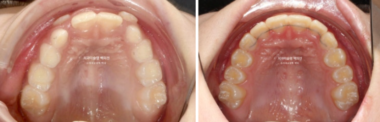 어린이 무턱 성장교정 덧니 인비절라인 퍼스트 악궁확장 치료기간 2년 관련 이미지 24