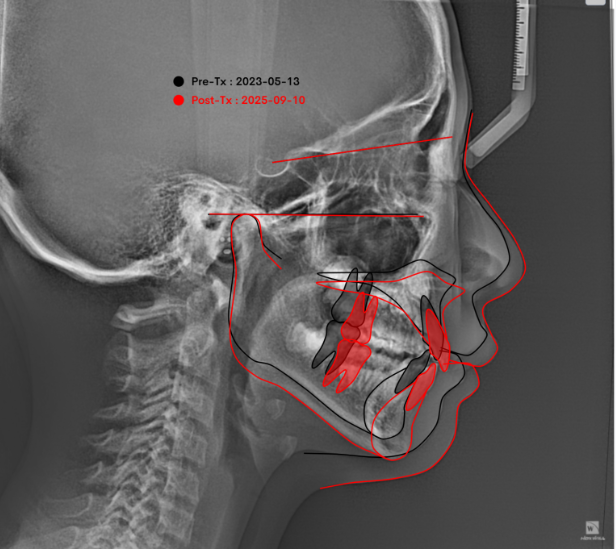 어린이 무턱 성장교정 덧니 인비절라인 퍼스트 악궁확장 치료기간 2년 관련 이미지 37