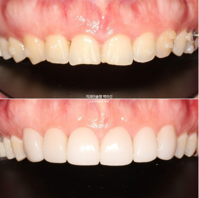 비발치 덧니 교정 인비절라인 과개교합 교정 무삭제 라미네이트 치료 후기 관련 이미지 23