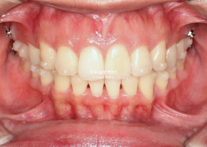 비발치 인비절라인 교정 돌출입 교정 후기 관련 이미지 10