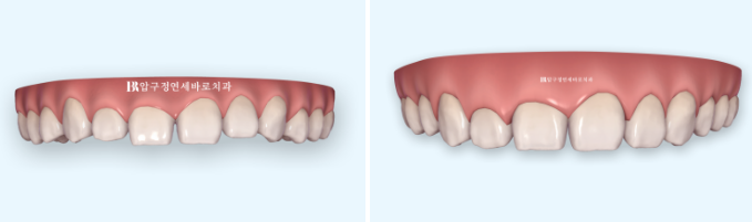 If Your Front Teeth Look Spaced Due to Peg-Shaped Teeth or Microdontia: A Case Choosing No-Prep Veneers Instead of Orthodontic Treatment image 3