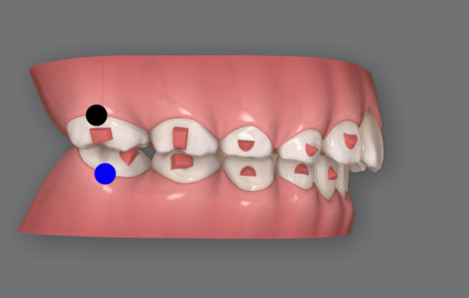 무턱교정 어린이 투명교정 인비절라인 퍼스트 교정 후기 관련 이미지 8