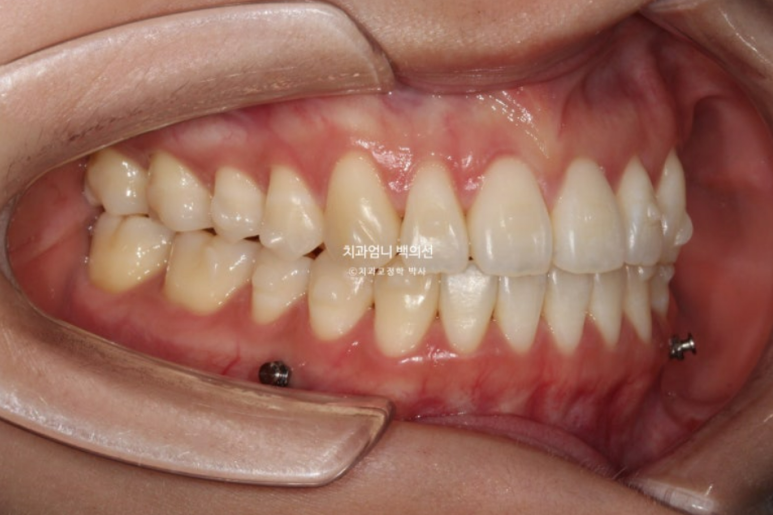 인비절라인 개방교합 교정 어금니 함입 교정 비베라? 관련 이미지 5