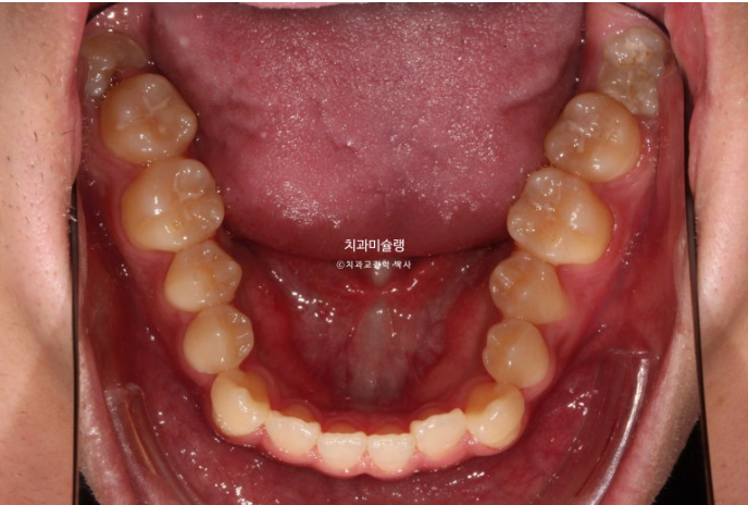 비수술 비발치 주걱턱 절충치료 클리피씨 개방교합 반대교합 치료 관련 이미지 5