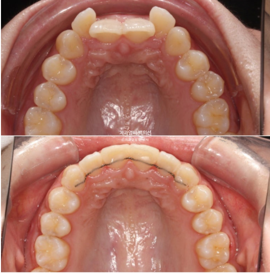 Inward-Tilted Teeth Orthodontic Treatment Review | A Real Case of Treating Congenitally Missing Lower Incisor (Three Lower Front Teeth) Without Extractions image 12
