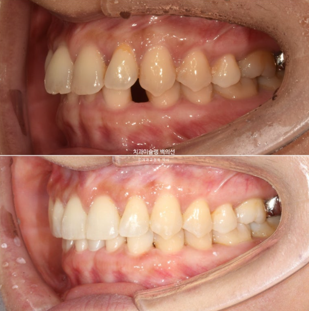 해외거주 앞니 선천적 결손 과개교합 인비절라인 라이트 브릿지 치료 관련 이미지 17