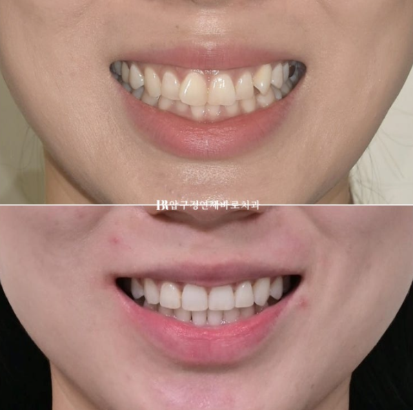 웃을 때 잇몸이 보여요. 잇몸미소 거미스마일 교정하기 관련 이미지 11