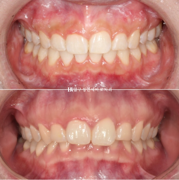 Can't Invisalign Move the Roots? An Actual Case of Extraction Treatment for Protruding Mouth at a Gangnam Orthodontic Clinic image 12