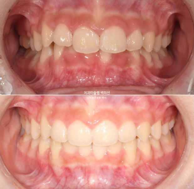 과개교합 인비절라인 모더레이트 컴프레헨시브 중심선 토끼이빨 관련 이미지 15