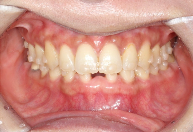 해외거주 앞니 선천적 결손 과개교합 인비절라인 라이트 브릿지 치료 관련 이미지 7
