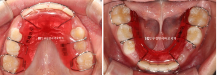 무턱교정 어린이 투명교정 인비절라인 퍼스트 교정 후기 관련 이미지 20