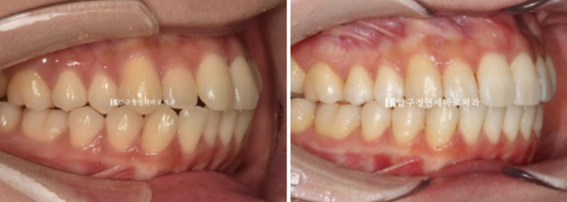 9-Month Invisalign Lite Review|Real Case Improving a Crossbite and Crooked Teeth Together image 8