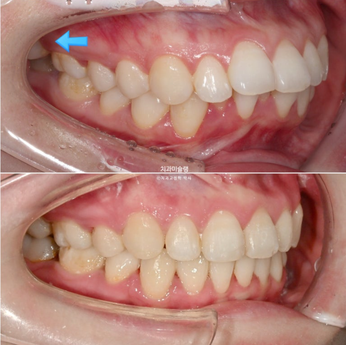 심한 돌출입 입술부전증 호두주름 발치교정 치료 관련 이미지 15