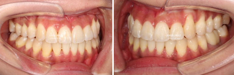 비발치 교정 덧니 인비절라인 교정 절단교합 반대교합 치료기간 1년 6개월 관련 이미지 19