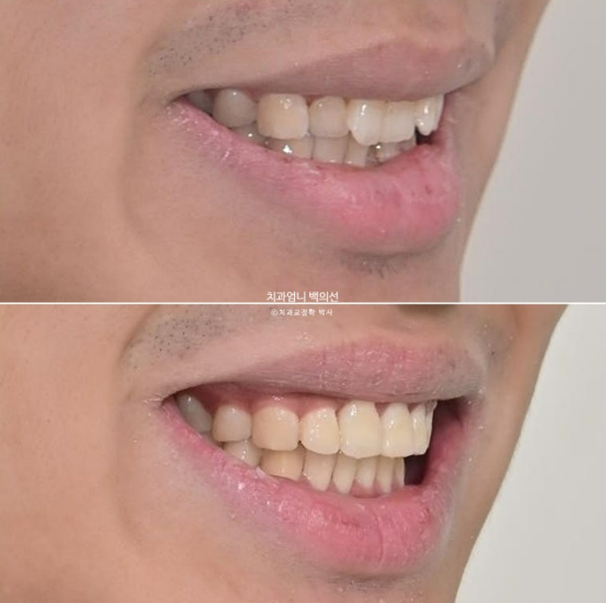 앞니 부분교정 덧니 교정 블랙트라이앵글 부정교합 마모 시뮬레이션 치료기간 5개월 관련 이미지 19