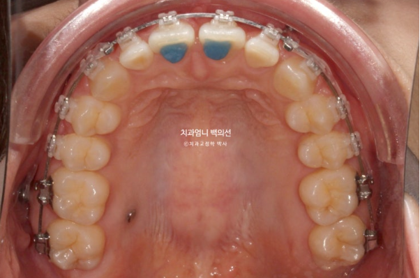 옥니 거미스마일 과개교합 교정, 잇몸돌출까지 개선한 비발치 클리피씨 교정 증례 관련 이미지 7