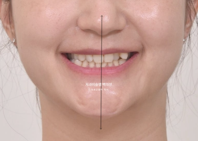 옥니 덧니 과개교합 반대교합 중심선 인비절라인 치료기간 1년 관련 이미지 6