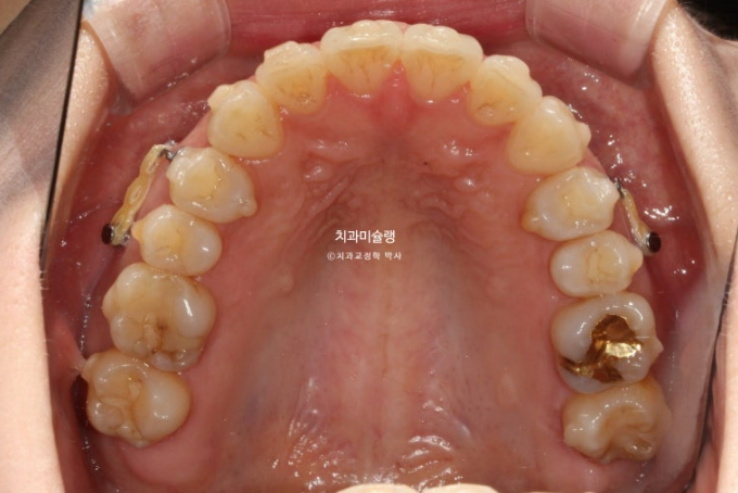 비발치 돌출입 인비절라인 교정 가위교합 중심선 맞추기 관련 이미지 16