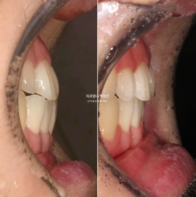 주걱턱 교정 반대교합 소구치 선천적 결손 부정교합 비발치 교정 후기 관련 이미지 14