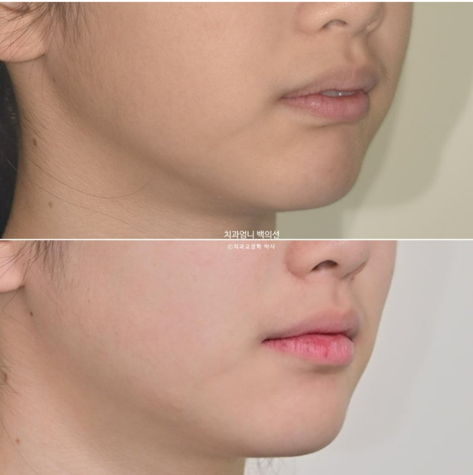 입이 안 다물어짐 입술부전증 호두턱 교정? 관련 이미지 14