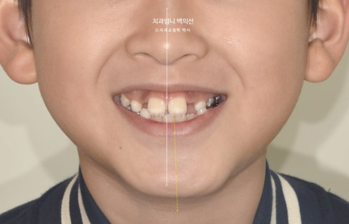 어린이 교정 인비절라인 퍼스트 비대칭 반대교합 어린이 성장 교정 관련 이미지 4