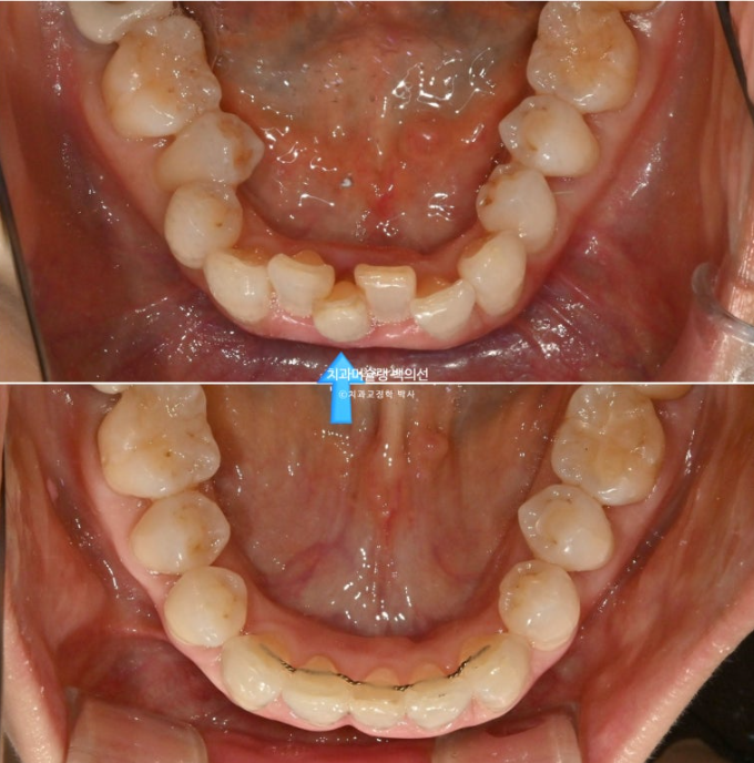 50대 치아교정 중년 발치교정 블랙트라이앵글 치료 후기 관련 이미지 20