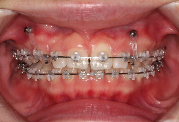 거미스마일 과개교합 교정 잇몸돌출 잇몸 비대칭 관련 이미지 5