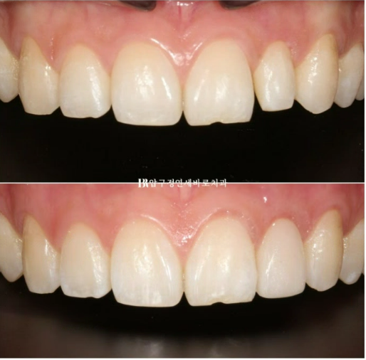 급속 교정 앞니부분교정 치료 무삭제 라미네이트 후기 관련 이미지 8