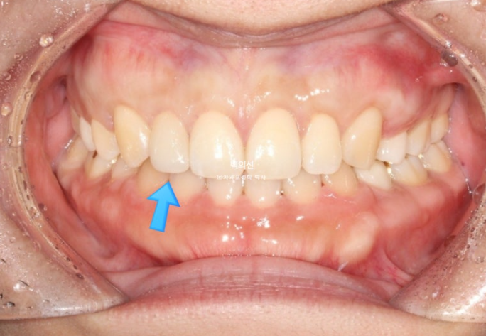 30대 치아교정 돌출입 교정 :: 잇몸미소 거미스마일 교정 입술부전증 결손치 무턱교정 관련 이미지 14