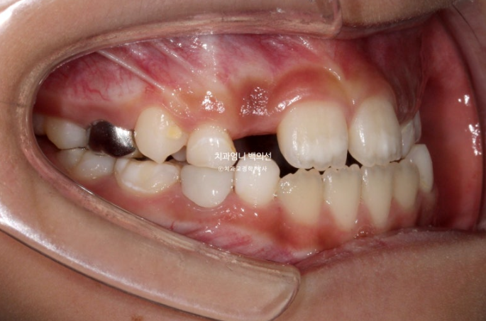 어린이 교정 인비절라인 퍼스트 비대칭 반대교합 어린이 성장 교정 관련 이미지 6