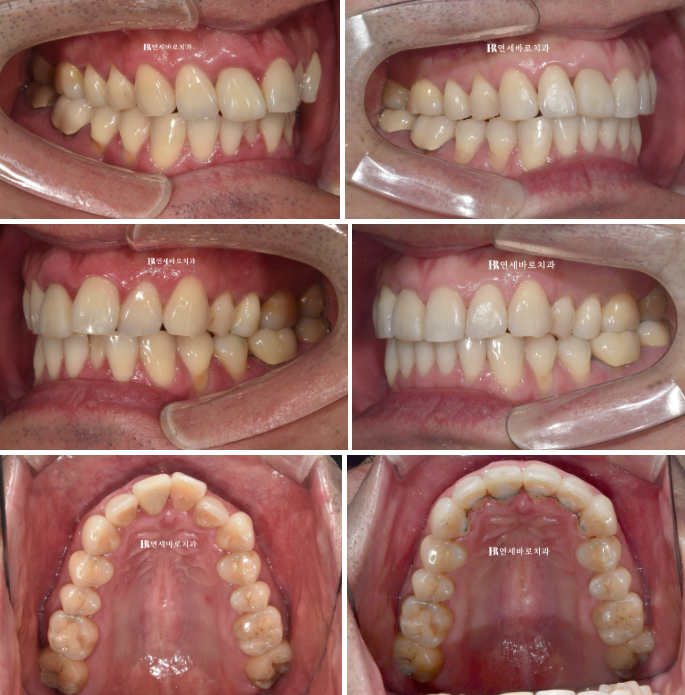 안보이는 앞니 교정 2D 교정 부분교정 후기 / 교정 시 잇몸이 더 나빠지지 않을까요? 관련 이미지 7