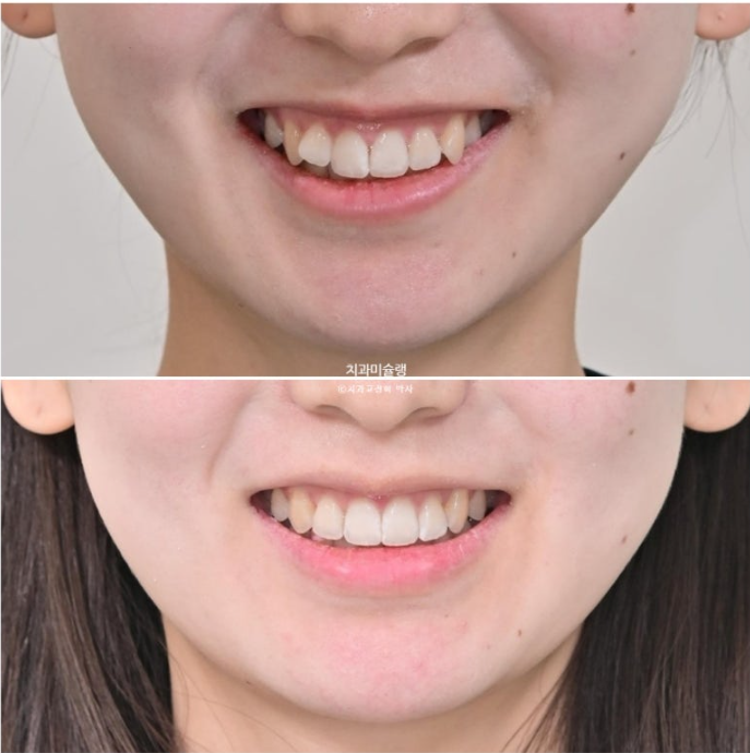 덧니 인비절라인 라이트 잇몸미소 거미스마일 중심선 블랙트라이앵글 관련 이미지 1