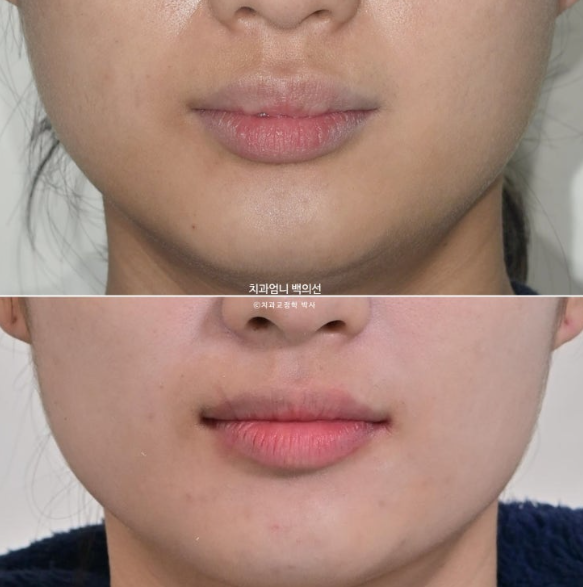 돌출입 교정 인비절라인 발치 교정 후기 관련 이미지 19