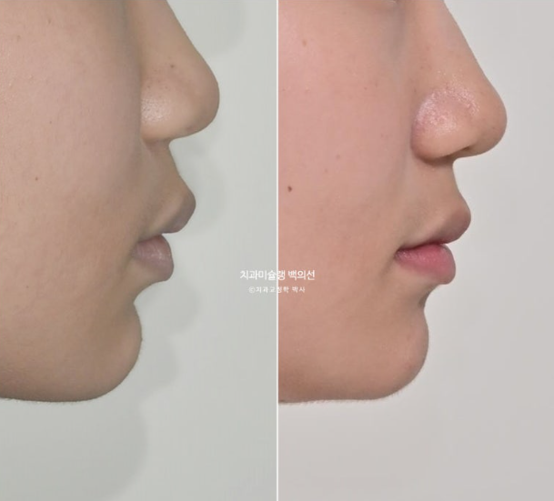 덧니 돌출입 발치교정 상악만 2개 편악 발치 클리피씨 입술부전증 치료 관련 이미지 18