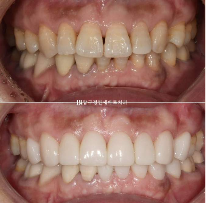 50대 라미네이트 삭제 없이 하는 법? 관련 이미지 3
