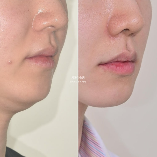 비대칭 비발치 거미스마일 잇몸미소 중심선 가위교합치료 무삭제 라미네이트 관련 이미지 28