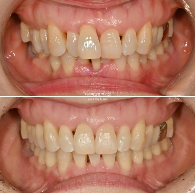 50대 치아교정 중년 발치교정 블랙트라이앵글 치료 후기 관련 이미지 1