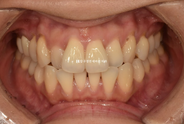 30대 토끼이빨 교정 반대교합 앞니 부분교정 후기 관련 이미지 2