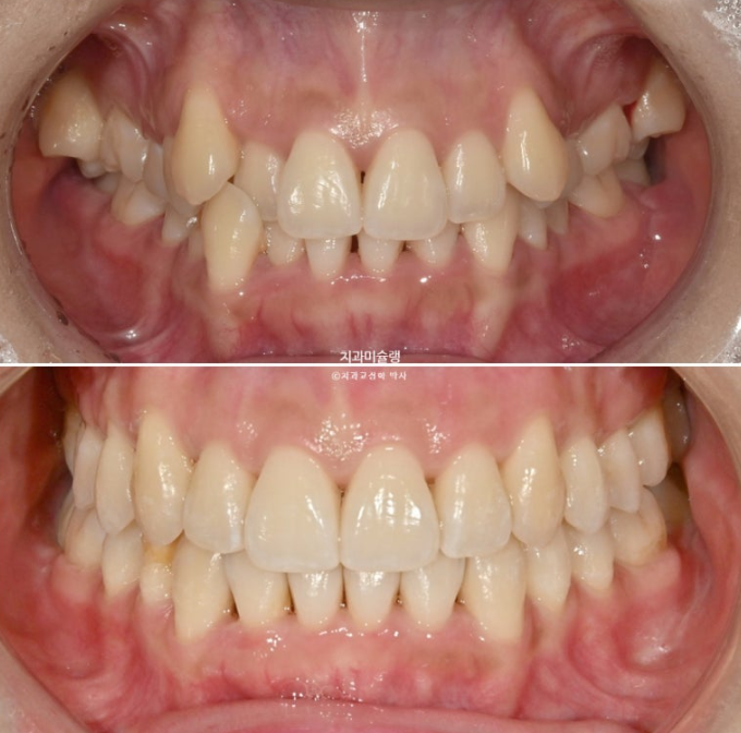 인비절라인 비발치 제2대구치 발치 사랑니 대체 교정 심한 덧니 교정 치료 관련 이미지 21